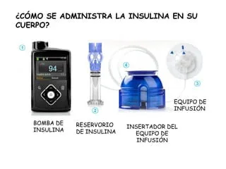 Cómo funciona la bomba de Insulina